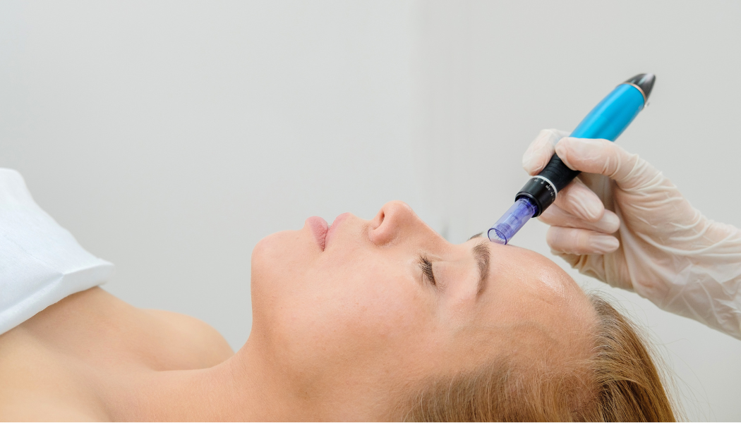 Microneedling and PRP